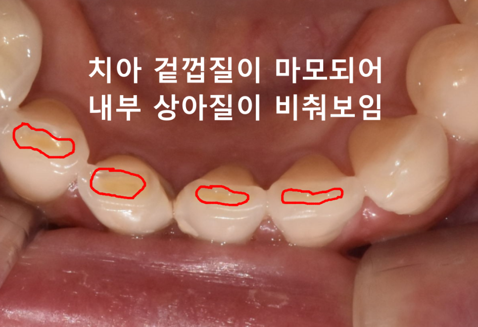 앞니 레진 떨어짐, 자꾸 반복된다면 관련 이미지 6