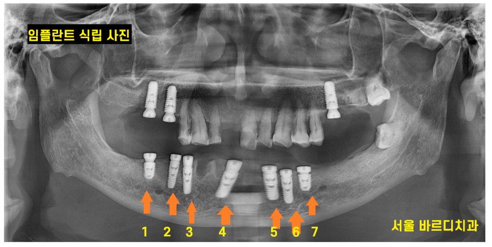 외국인 치과 진료 하악 전체 임플란트 7개 심어 12개 치아 만들기 관련 이미지 8