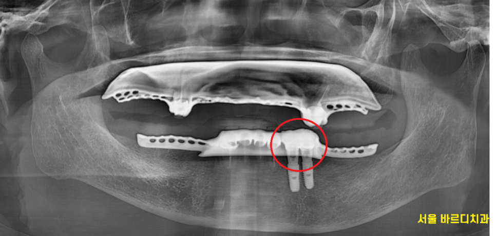 강일동 치과추천 틀니 사용중 치아 부러짐 임플란트로 복구했습니다. 관련 이미지 9