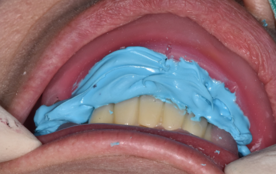 고덕역 치과 위아래 전체 임플란트 디지털을 사용하는 이유? 관련 이미지 8