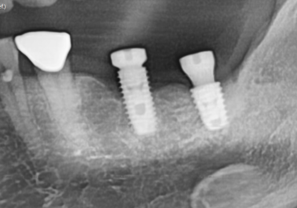천호동 임플란트 재식립 사례, 평생 쓰는 줄 알았는데? 관련 이미지 11