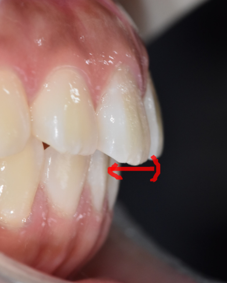 3 Ways to Fix Gaps Between the Front Teeth with Orthodontic Treatment image 3