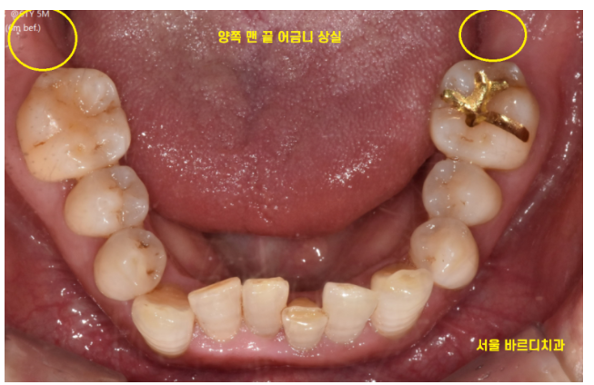 하남시청치과 내비게이션 임플란트 왜 좋다는거죠? 관련 이미지 3