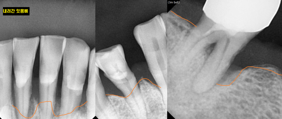 강일동 임플란트 위아래 치아 흔들림과 통증이 있을 때 방법은? 관련 이미지 5