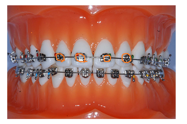 치아 교정기 종류 결정장애 환자분들을 위한 친절한 설명서 관련 이미지 4