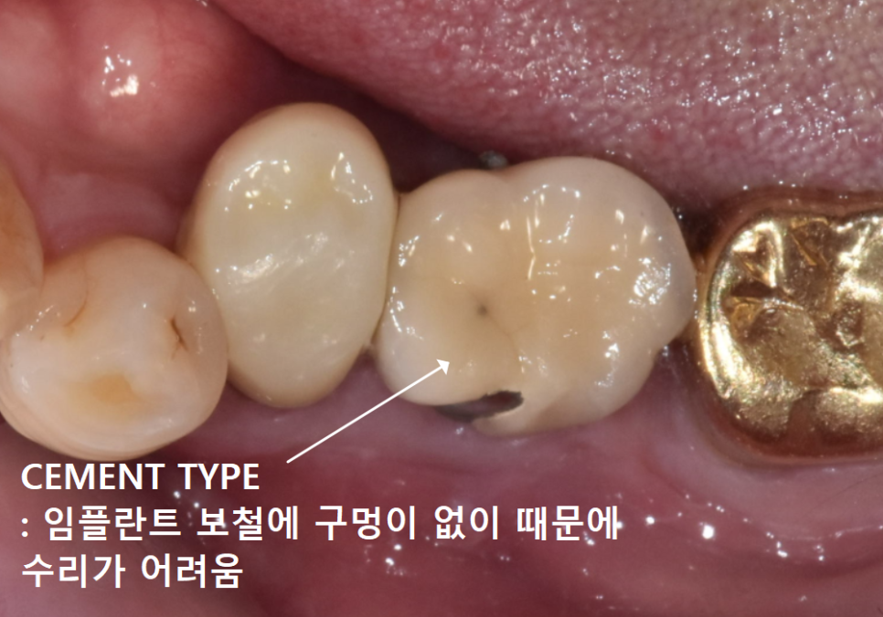 상일역 임플란트, 음식물 끼는 이유, 처음엔 안 그랬는데 왜 점점 심해지는 걸까요? 관련 이미지 12