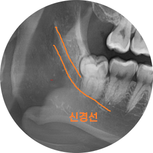 상일동 치과 매복 사랑니 발치 비용 정리해보았습니다!! 관련 이미지 2
