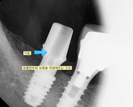 위아래 임플란트 동시에 하여 치료기간 단축하기 관련 이미지 8