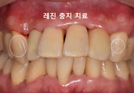 강동구 앞니 충치, 누구는 레진이고 누구는 임플란트인 관련 이미지 13