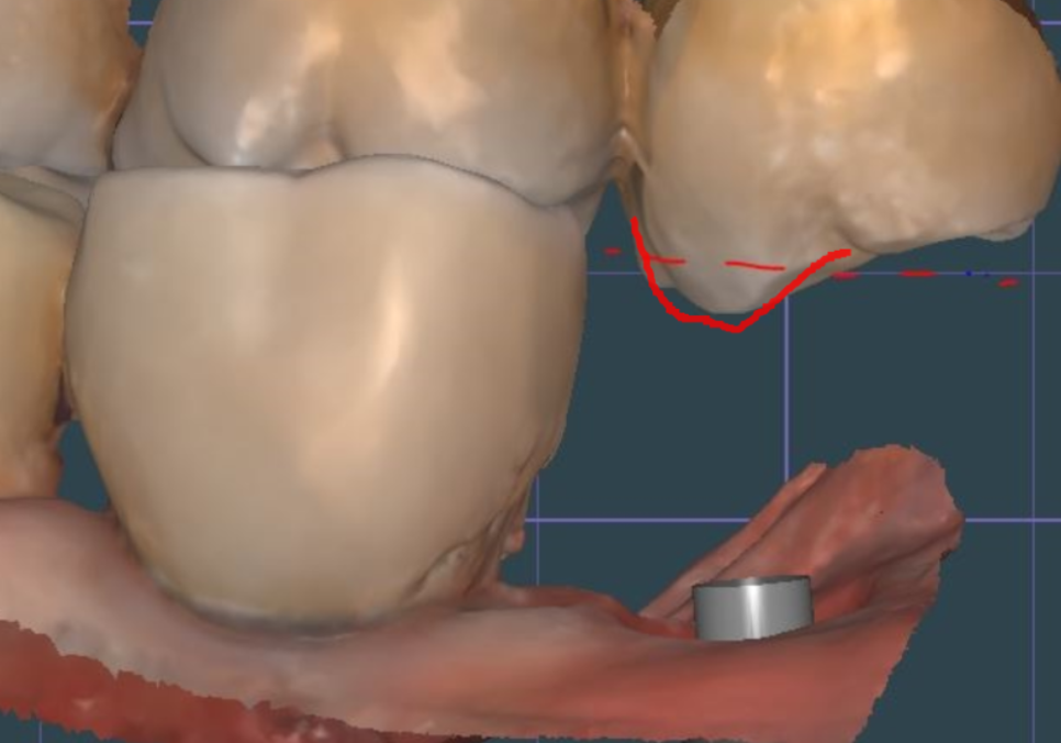 발치 후 빈 공간, 이 빼고 오래 냅두면 이렇게 됩니다. 관련 이미지 11