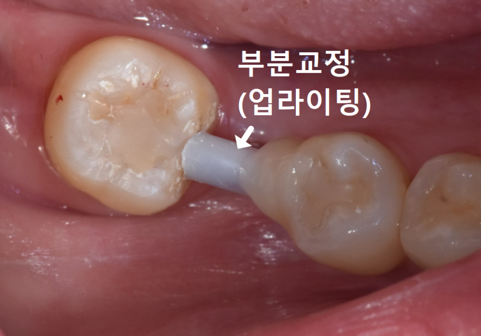 No space for an implant because a tooth has fallen over or a molar has tilted? Read this first. image 5