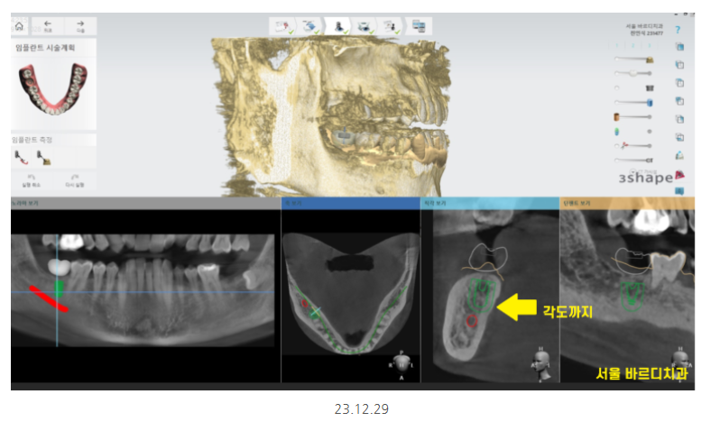 하남시청치과 내비게이션 임플란트 뭐가 좋아요?? 관련 이미지 4