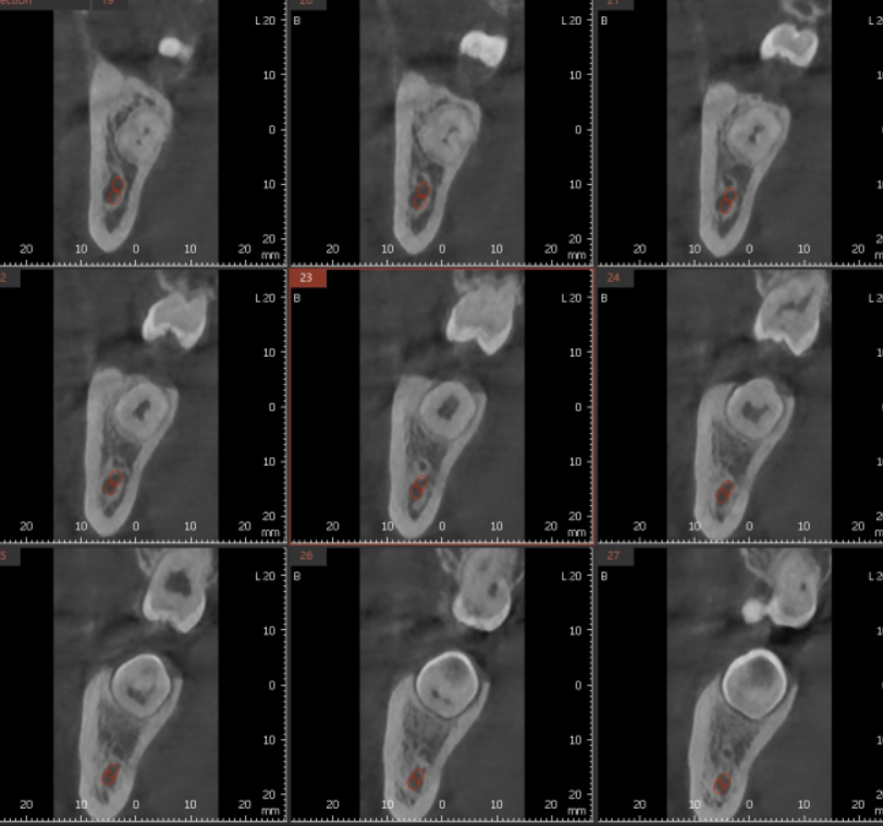 상일동 사랑니 발치  시간, 비용 절약하는 3가지 꿀팁 공개~! 관련 이미지 4