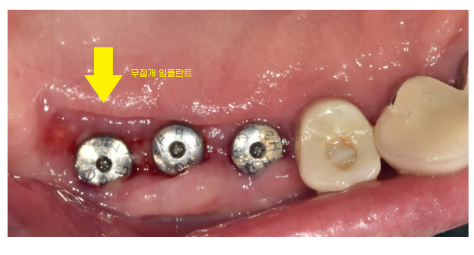 예전에 씌운 이 상악동 거상술 뼈이식 동반하여 임플란트 완료 관련 이미지 6