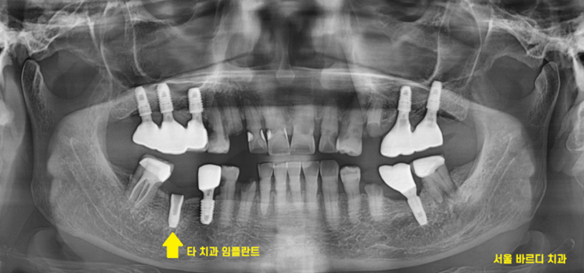 타치과 임플란트 as 수리 가능한 선동치과 관련 이미지 2