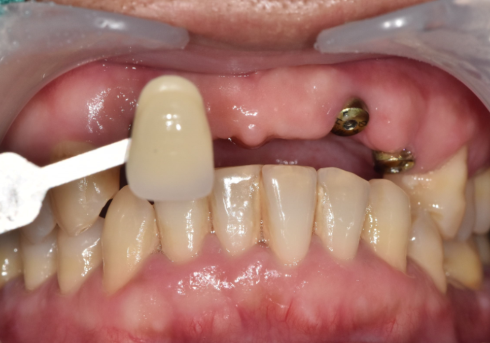 앞니 브릿지 부러짐, 이런 상태라면 절대 브릿지 다시 하지 마세요. 관련 이미지 13