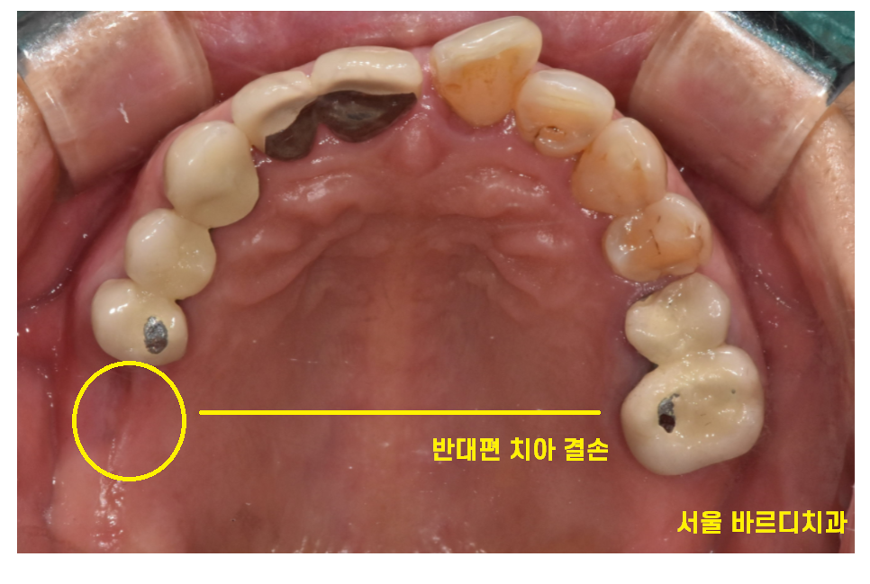 암사동 치과 골다공증 치료 중 임플란트 가능한가요?? 관련 이미지 5