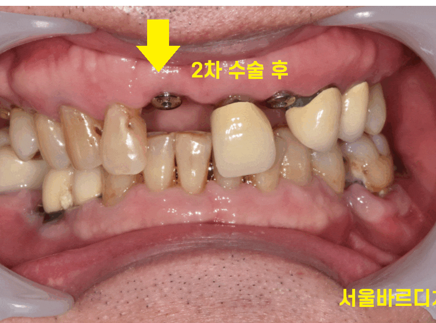 임플란트 2차 수술 과정 아직도 안끝났어요? 죄송합니다!! 관련 이미지 1