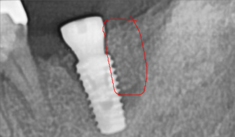 바르디 임플란트는 바르게 심지만, 빠르게 씹습니다. 그간의 경험을 바탕으로요. 관련 이미지 10