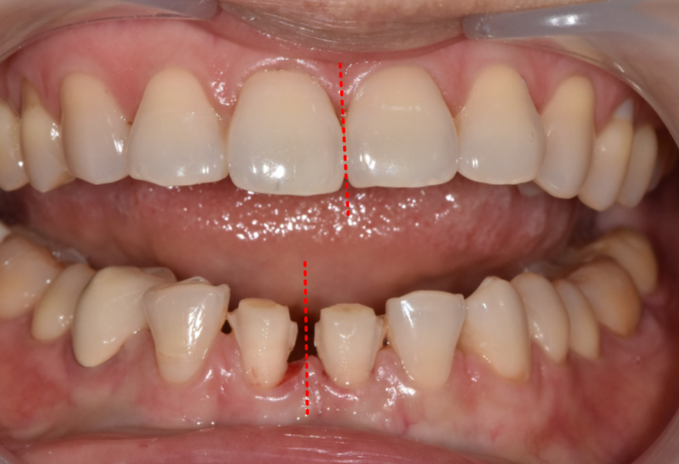 앞니 레진 떨어짐, 자꾸 반복된다면 관련 이미지 9