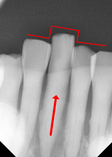 솟구치는 앞니, 흔들리는 치아가 보내는 관련 이미지 4