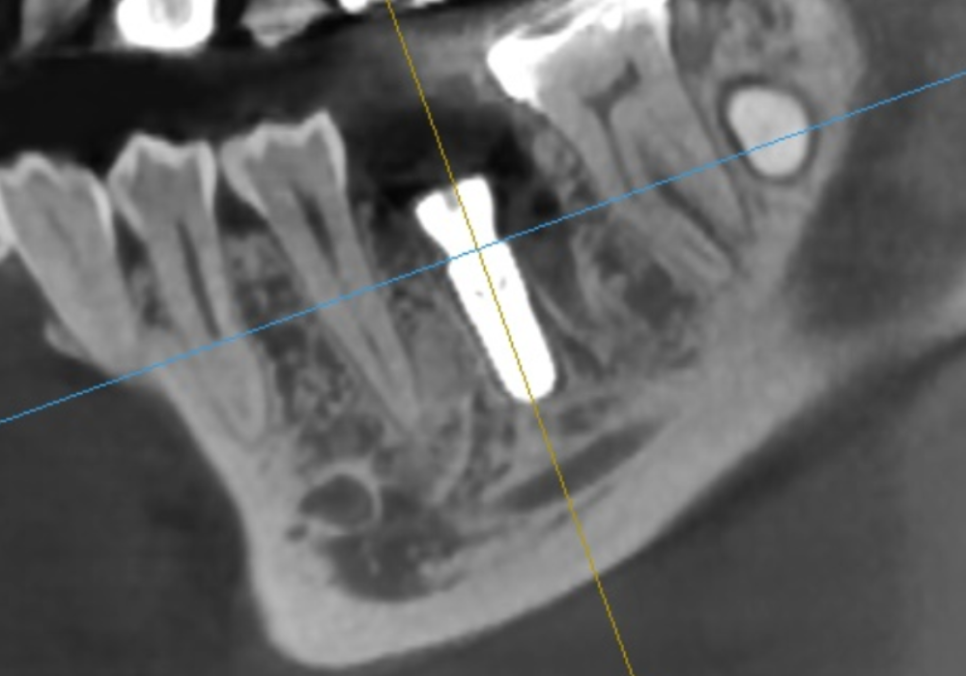 Honestly, Can an Unbroken Temporary Tooth Be Used Without a Crown? image 14