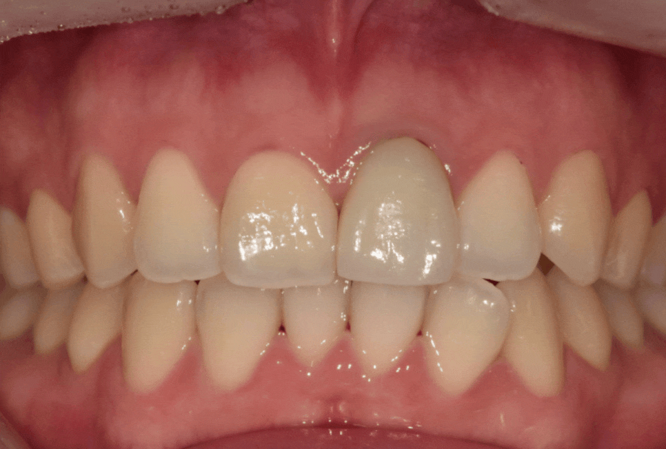 명일동 치과, 잇몸이 검게 변했다면? 앞니 변색 원인은 바로 관련 이미지 17
