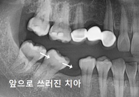 No space for an implant because a tooth has fallen over or a molar has tilted? Read this first. image 1