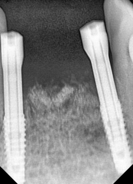 흔들리는 치아 묶어두는 잠간고정술, 오히려 잇몸뼈를 녹일 수도 있다고요? 관련 이미지 11