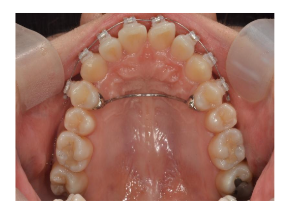 치아교정 중 발생하는 구내염 왜 발생할까? 관련 이미지 3