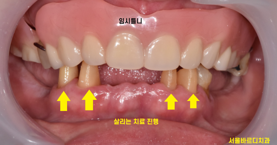 강동구 임플란트 어금니 상실 방치하다 치매까지 옵니다. 관련 이미지 8