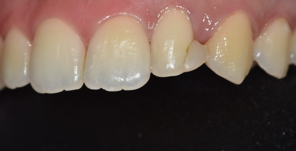 앞니 레진 변색으로 무삭제 라미네이트 진행했습니다. 관련 이미지 5