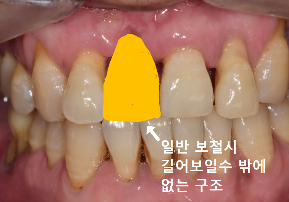 앞니 잇몸 꺼짐, 잇몸 이식 없이도 임플란트 할 수 있는 방법 공개합니다. 관련 이미지 12