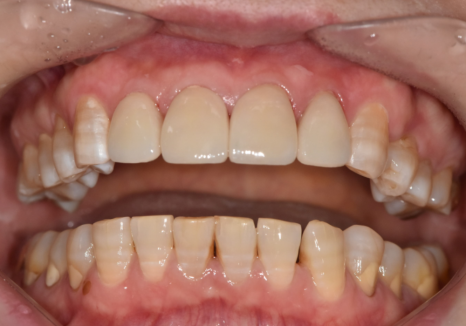 50대 라미네이트, 앞니 벌어짐과 변색 고민 이렇게 해결했습니다. 관련 이미지 10