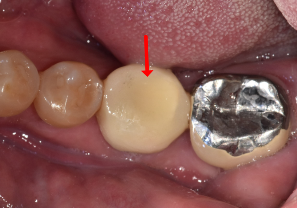 Honestly, Can an Unbroken Temporary Tooth Be Used Without a Crown? image 9