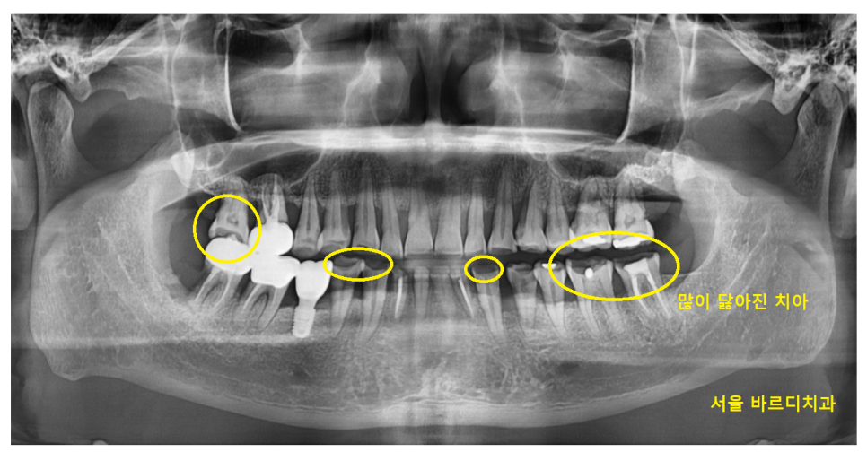 어금니 금감 발치 후 임플란트 풍산동 치과에서 진행했습니다. 관련 이미지 2