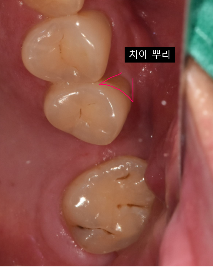 쓰러진 치아 교정 후 임플란트 이럴때 좋습니다! 관련 이미지 6