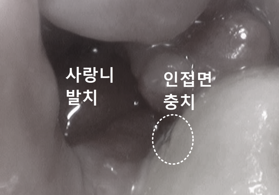 고덕동 사랑니 매복 발치, 안 아픈데 꼭 빼야 하나요? 관련 이미지 6