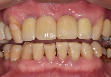 앞니 흔들림, 임플란트 치아보험 감액 기간 넘기려다 더 큰 손해 봅니다. 관련 이미지 12