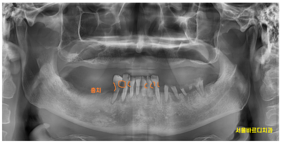 고덕역  치과 틀니쓰다 위아래 전악 임플란트 재건했습니다. 관련 이미지 3