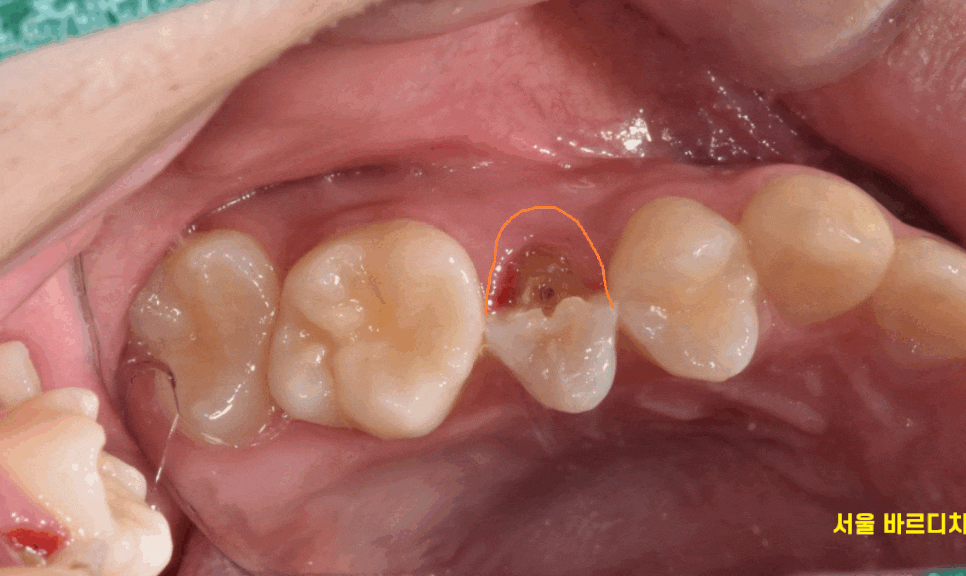 강일동 치과 추석 명절 딱딱한 음식은 절대 피하세요 치아 골절 생깁니다. 관련 이미지 1