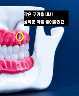 치아 쪼개짐으로 상악동 거상술 동반한 임플란트 수술 관련 이미지 7