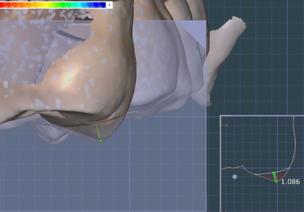 발치 후 빈 공간, 이 빼고 오래 냅두면 이렇게 됩니다. 관련 이미지 12
