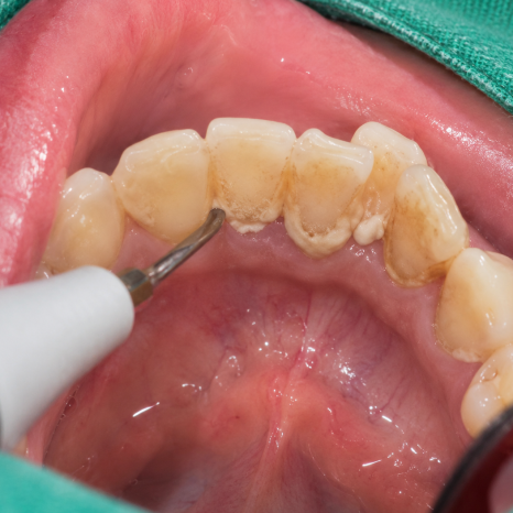 My Teeth Feel More Sensitive After Scaling (+ Causes and Ways to Reduce Sensitivity) image 2