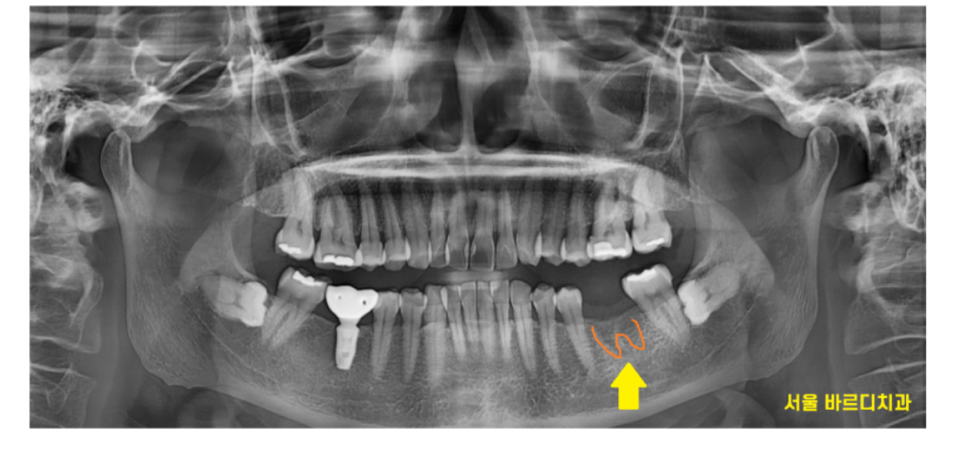 고덕동 치과 발치 후 방치하면 치아 쓰러짐 발생해요 관련 이미지 3