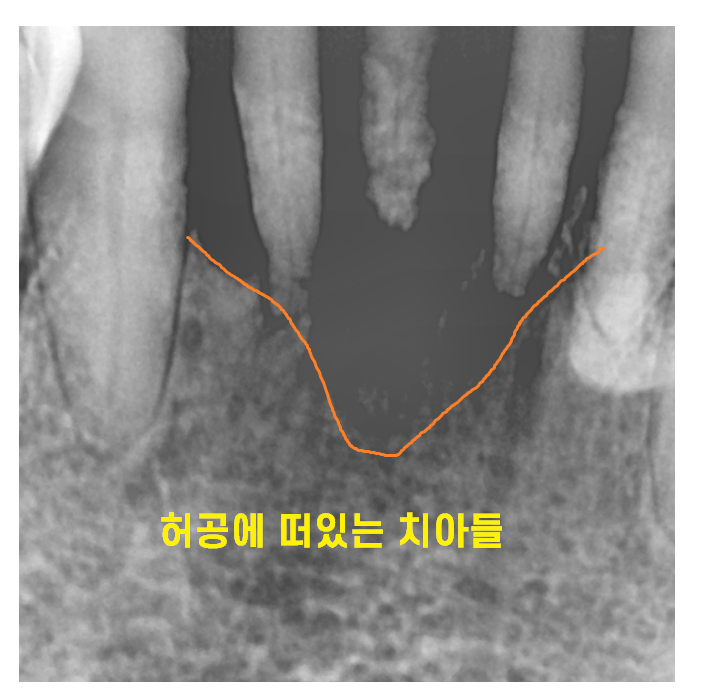 전체적인 치아 치료 13개의 임플란트를 식립한 환자분 관련 이미지 5