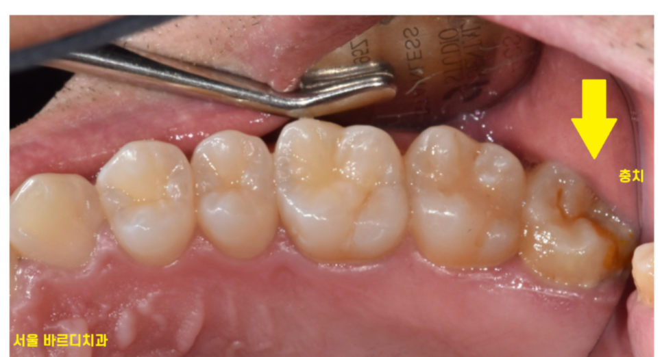 맨 끝 어금니 임플란트 먼저 무너지는 이유가 있습니다. 관련 이미지 2