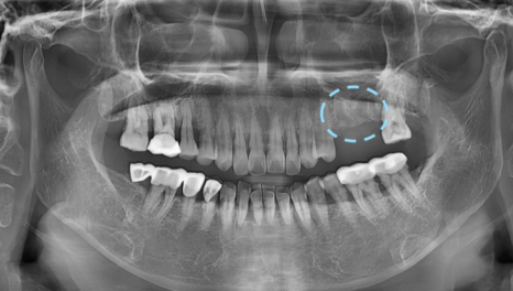 서울 네비게이션 임플란트 치과 불안할 때 좋은 선택지가 될 수 있습니다. 관련 이미지 6