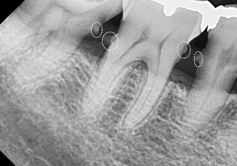 고덕동 스케일링 미루다 앞니 어금니 다 뽑고 임플란트 했습니다. 관련 이미지 12