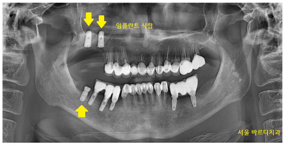 명일동 치과 뿌리 염증으로 입냄새가 나요 해결책은? 관련 이미지 7